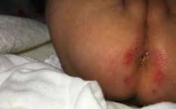 宝宝屁眼豆豆图片是什么？