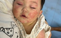 宝宝韭菜过敏图片大全