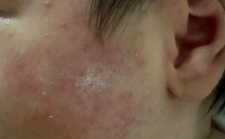 宝宝红薯过敏图片有哪些症状表现？
