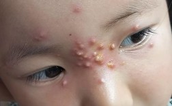 宝宝吃火龙果起疙瘩是过敏吗？