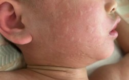 宝宝芹菜过敏图片有哪些症状？