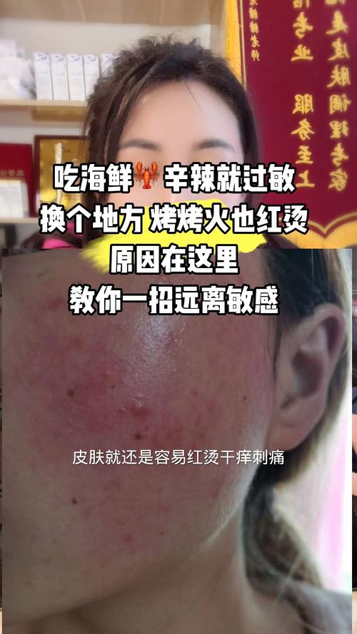 吃海鲜过敏可以喝茶吗-图2 吃海鲜过敏可以喝茶吗-图2