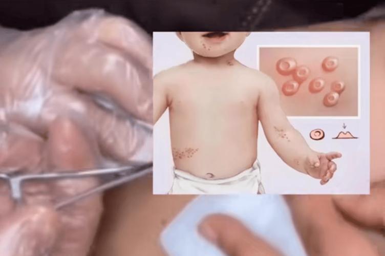 宝宝吃了虾皮起了疙瘩-图2 宝宝吃了虾皮起了疙瘩-图2