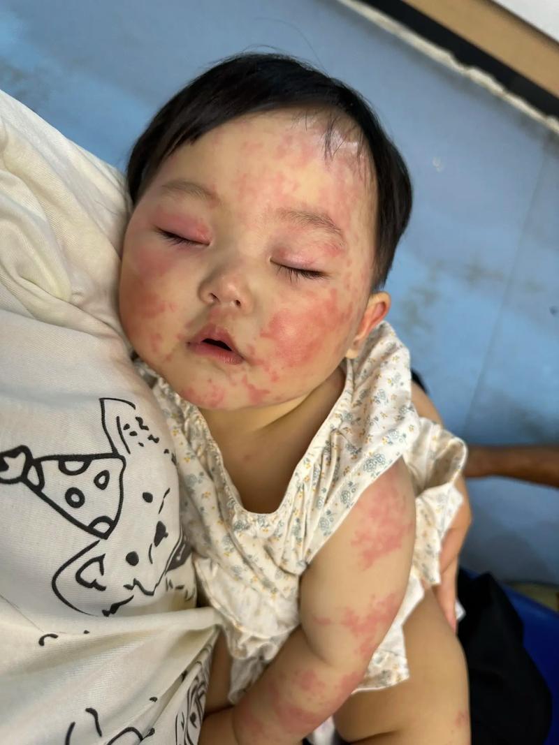 宝宝韭菜过敏图片大全-图1 宝宝韭菜过敏图片大全-图1