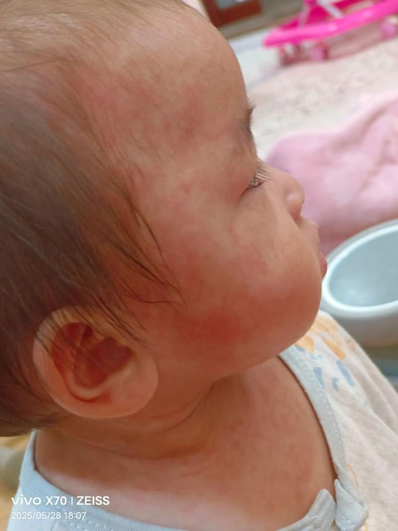 宝宝吃完带鱼脸上发红-图2 宝宝吃完带鱼脸上发红-图2