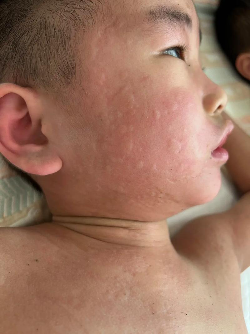 宝宝芹菜过敏图片有哪些症状？-图1