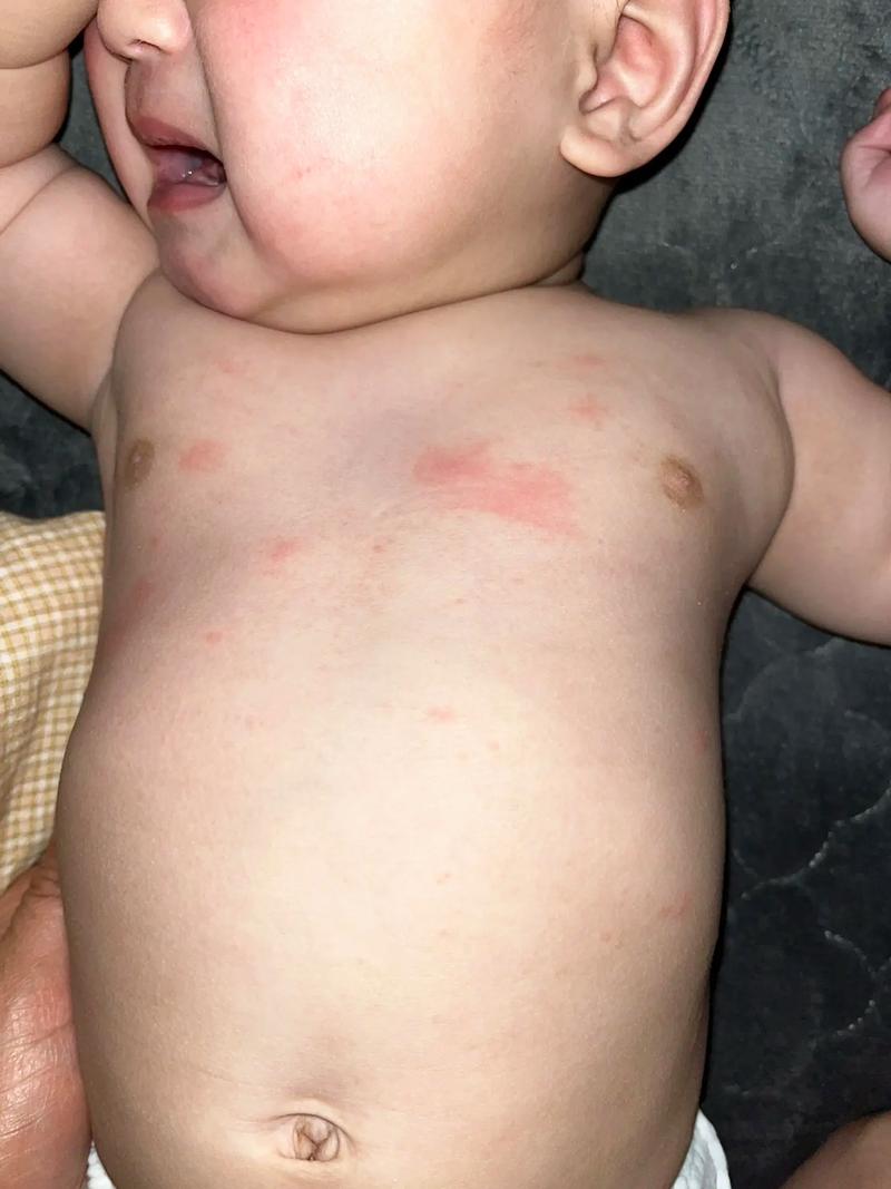 宝宝芹菜过敏图片有哪些症状？-图2