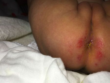 宝宝屁眼豆豆图片是什么?-图1 宝宝屁眼豆豆图片是什么?-图1