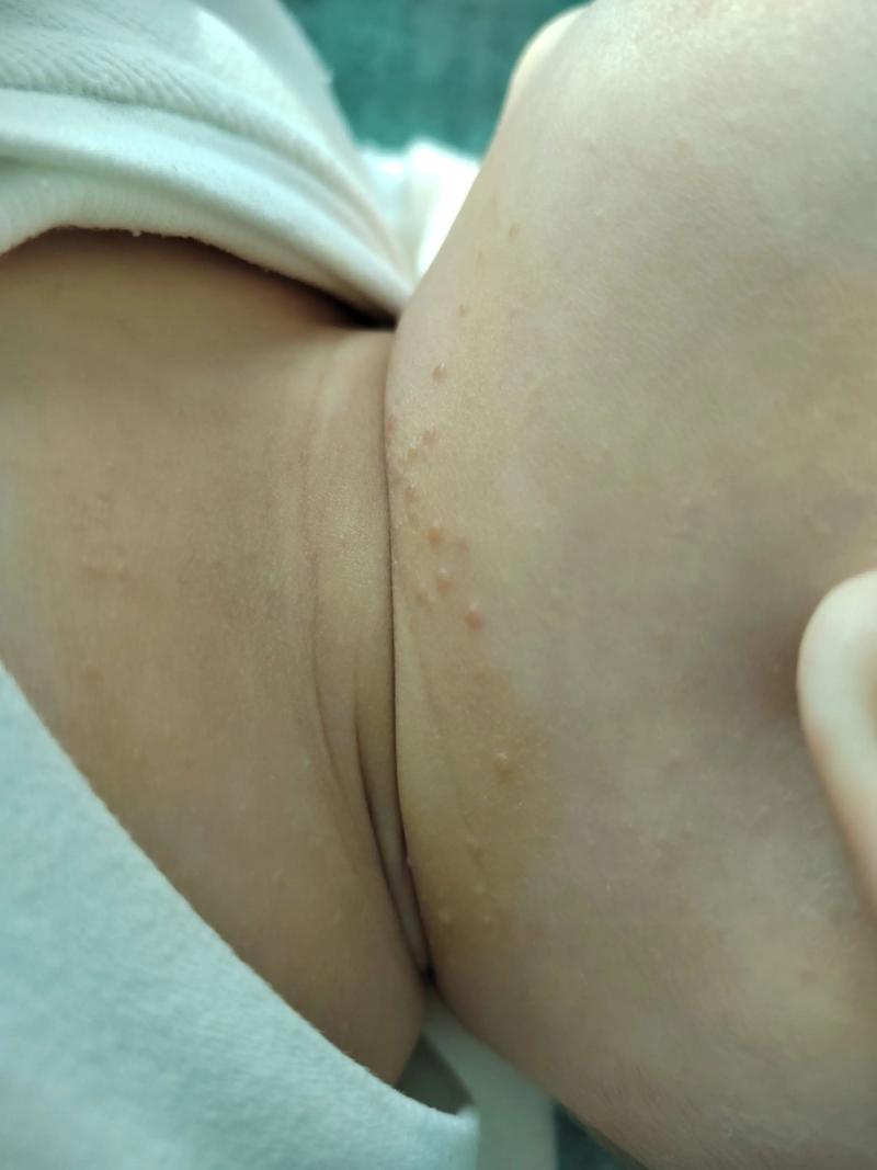 宝宝屁眼豆豆图片是什么？-图2