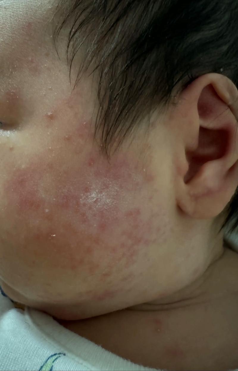 宝宝红薯过敏图片有哪些症状表现?-图1 宝宝红薯过敏图片有哪些症状表现?-图1