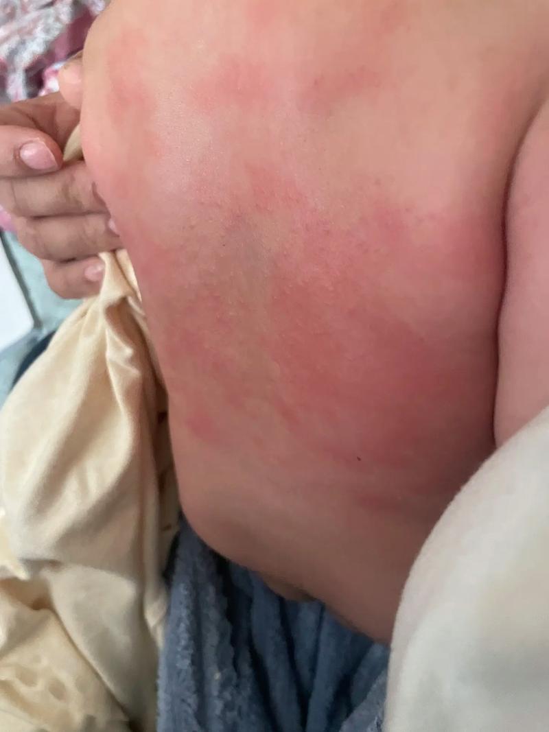 宝宝红薯过敏图片有哪些症状表现？-图3