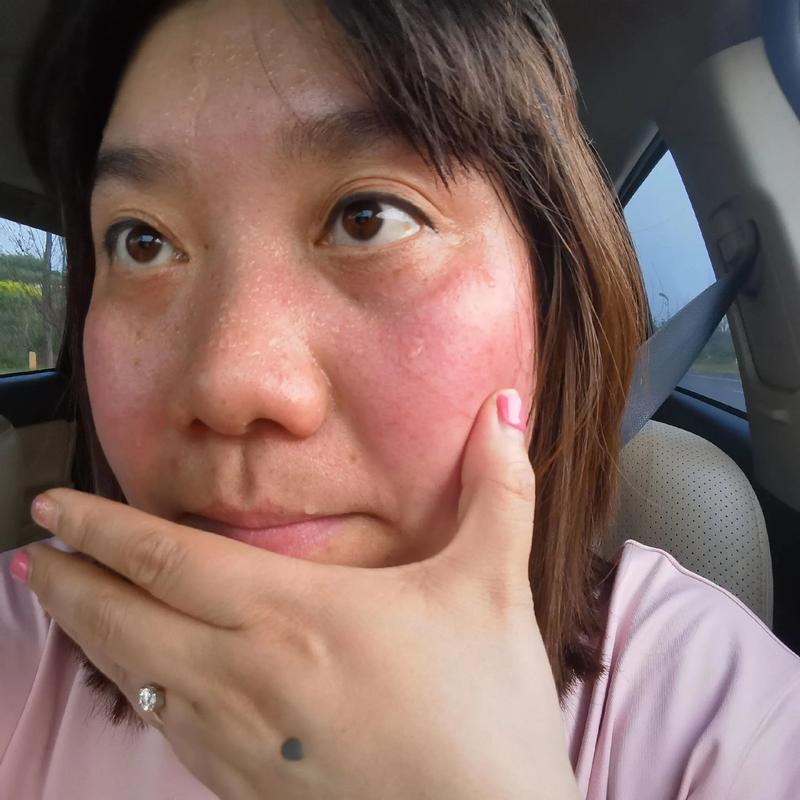 海鲜丸子吃后脸颊发红是过敏吗？-图2