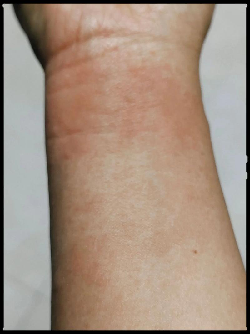 为何仅对螃蟹过敏，其他海鲜却没事？-图2