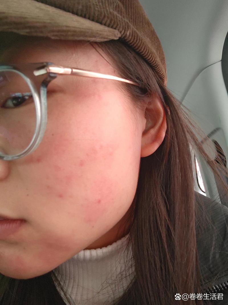 虾仁粥过敏怎么办?-图3 虾仁粥过敏怎么办?-图3